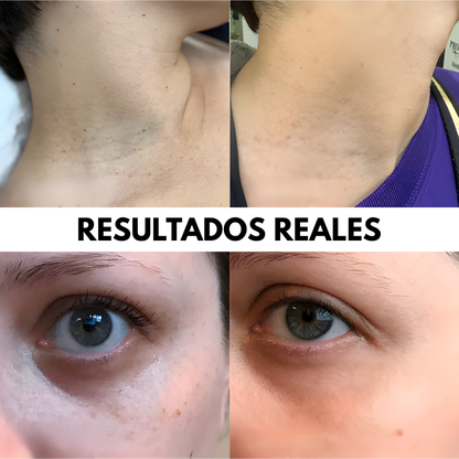 ELIMINADOR DE VERRUGAS – Piel más limpia, uniforme y segura desde casa