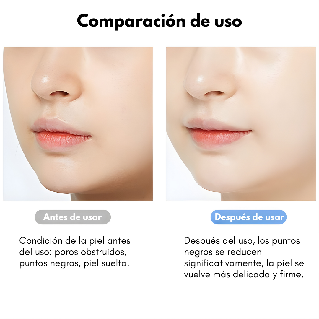 ESPÁTULA ULTRASÓNICA FACIAL – Limpieza profunda, poros más finos y piel suave sin irritación