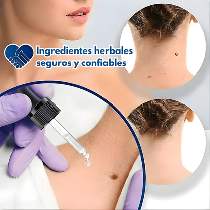 ELIMINADOR DE VERRUGAS – Piel más limpia, uniforme y segura desde casa