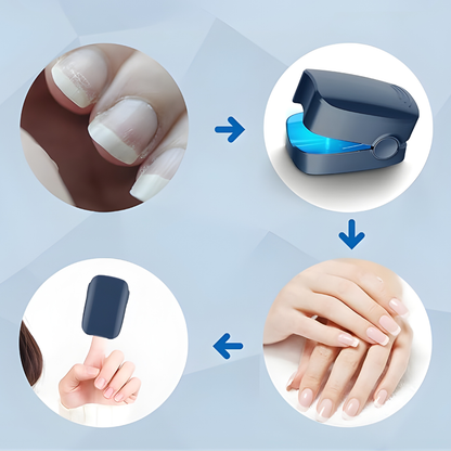 LÁSER PARA HONGOS EN LAS UÑAS – Tratamiento preciso, alivio duradero y tecnología profesional para recuperar uñas saludables