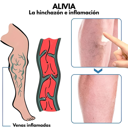 GEL PARA VENA VARICE — Alivio visible para piernas cansadas y venas