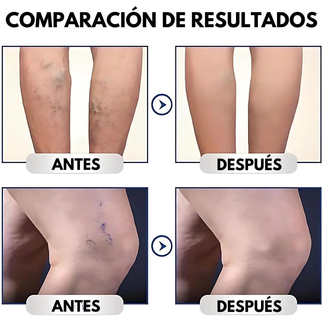 GEL PARA VENA VARICE — Alivio visible para piernas cansadas y venas
