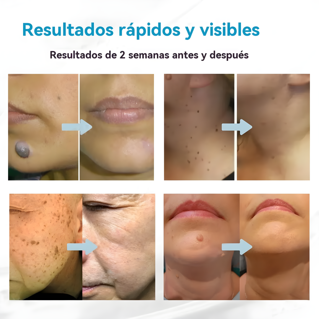 PLUMA ELIMINADORA DE ACNÉ – Regenera, suaviza y mejora el aspecto de tu piel